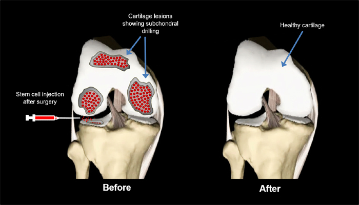 Stem Cell Cartilage Regeneration Market